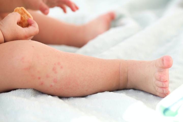 Chicken pox on toddlers leg for article about home remedies for Chickenpox